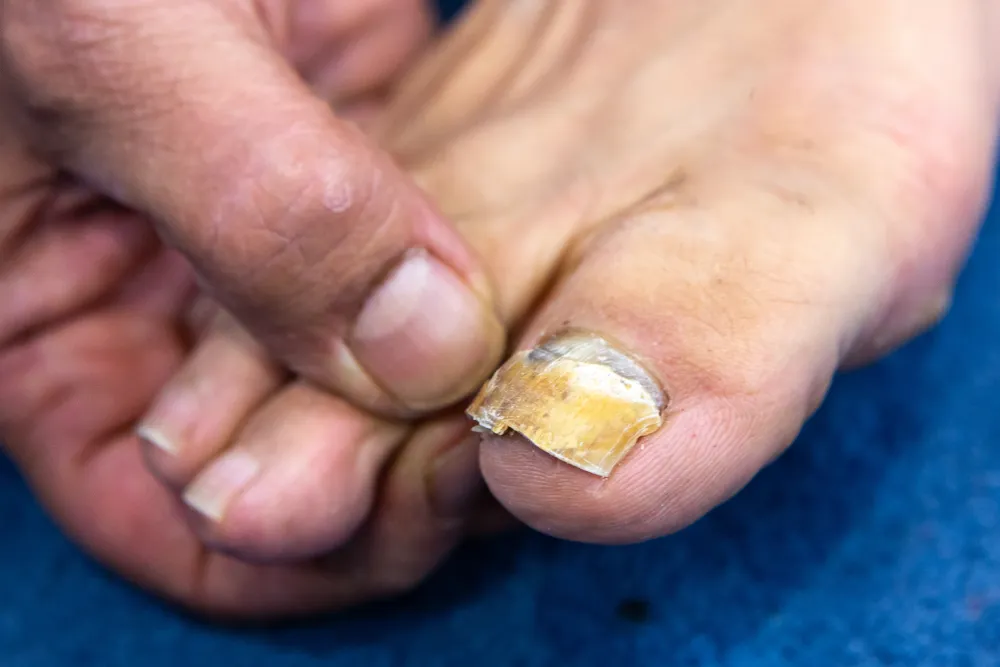 Großer Zeh mit fortgeschrittenem Nagelpilz, der Nagel ist gelb verfärbt und brüchig